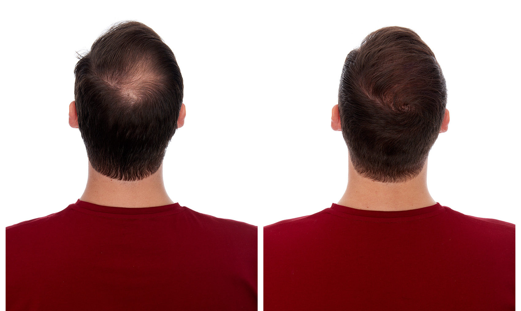 MicroPoint - Non-Surgical Hair Loss Solution - Hans Wiemann St. Louis